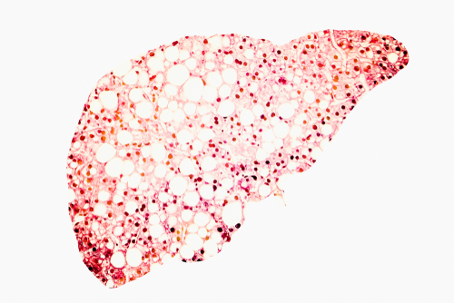 Approccio semiautomatico per stimare il grado di Non-Malattia del fegato grasso alcolica (NAFLD) da immagini ad ultrasuoni